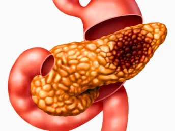 pancreatic
